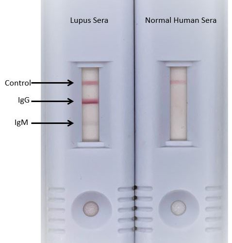 La(SSB) antibody serological assay (LSA)