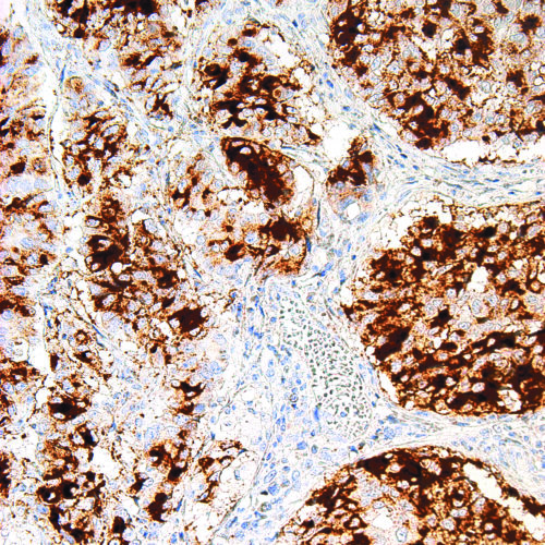 BG8-LewisY-IHC517-Lung