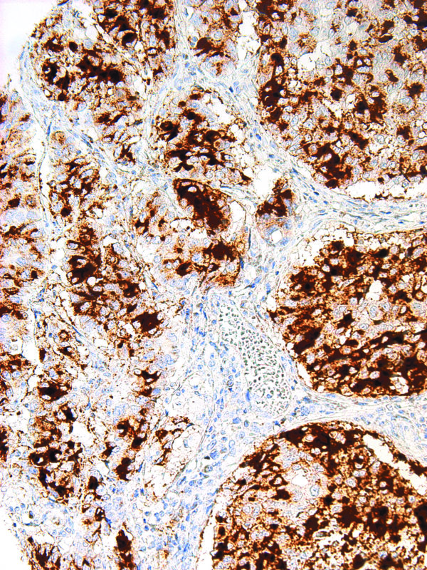 BG8-LewisY-IHC517-Lung