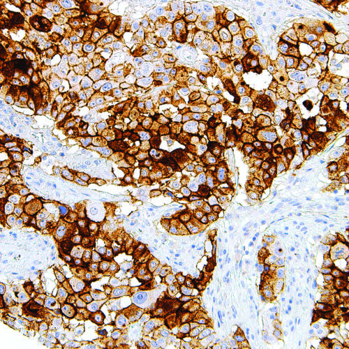 CA-125-IHC125-Pancreas