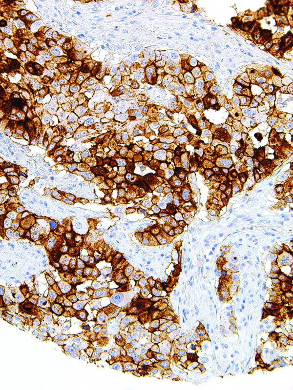 CA-125-IHC125-Pancreas