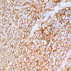 CD138-IHC138-Liver-Cancer