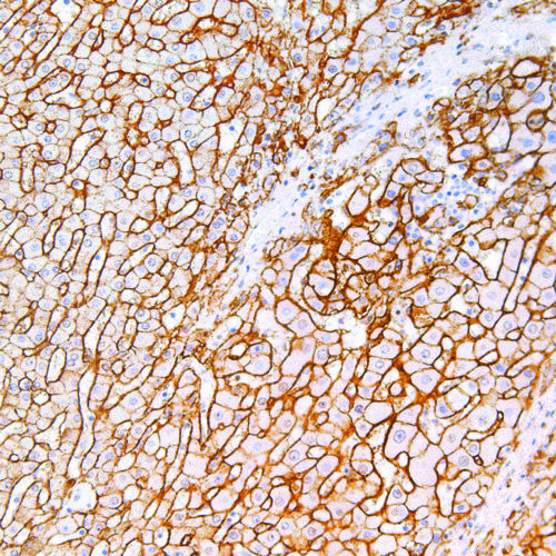 CD138-IHC138-Liver-Cancer