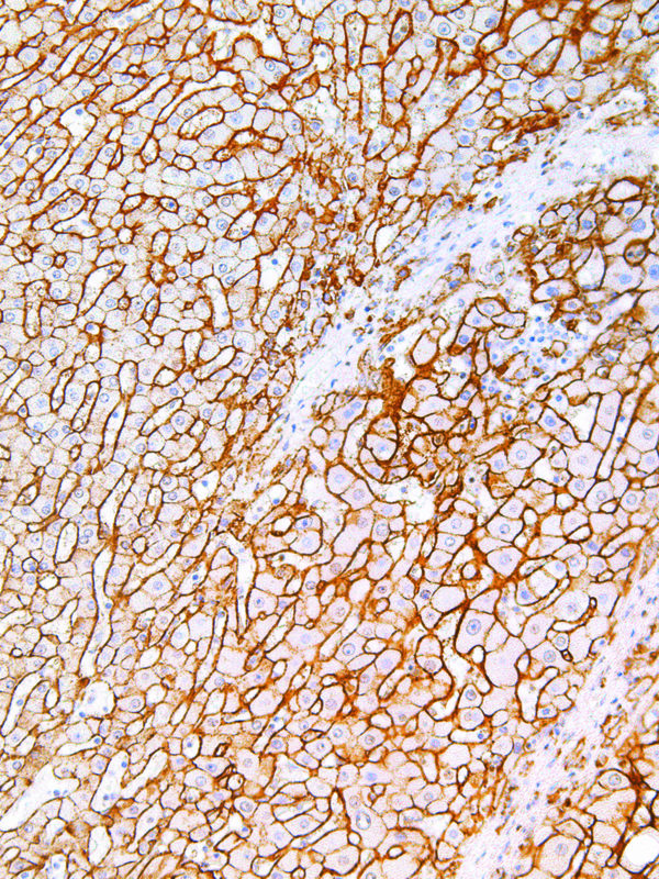 CD138-IHC138-Liver-Cancer