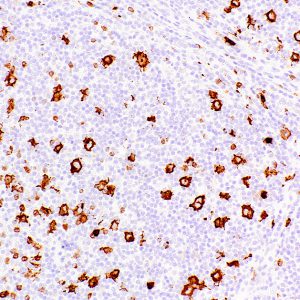 CD15-Leu-M1-IHC527-Hodgkin's-Lymphoma
