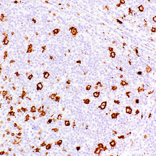 CD15-Leu-M1-IHC527-Hodgkin's-Lymphoma