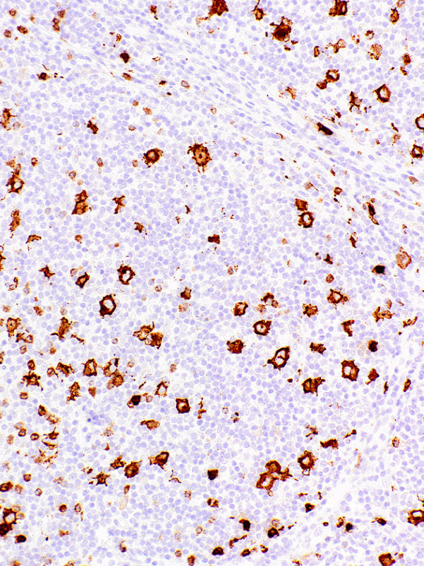 CD15-Leu-M1-IHC527-Hodgkin's-Lymphoma