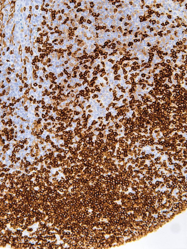 CD5-IHC538-Tonsil