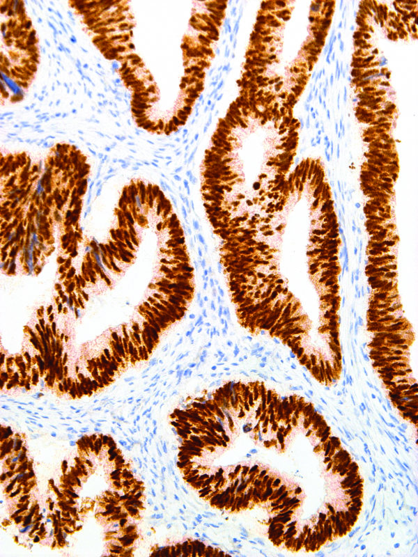 CDX-2-IHC402-Colon