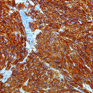 DOG1-IHC562-GIST
