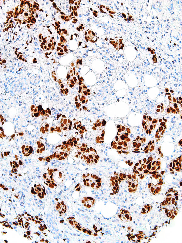 GATA3-IHC583-Breast