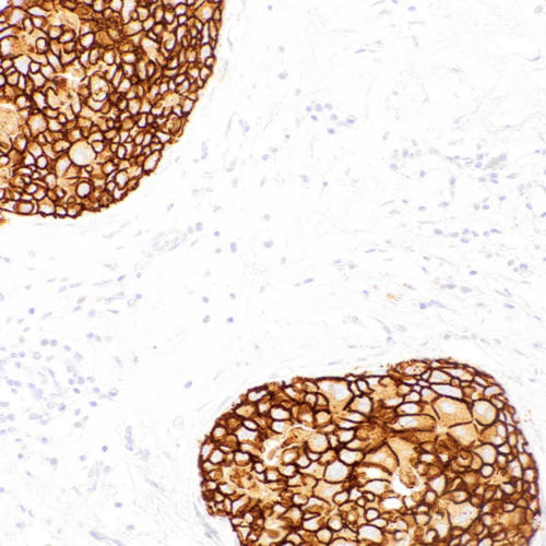 HER2-IHC002-Breast-Cancer