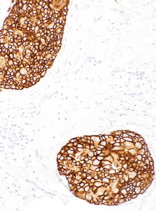 HER2-IHC002-Breast-Cancer