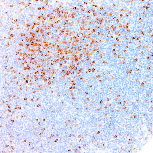 Hairy-Cell-Leukemia-IHC687-Tonsil