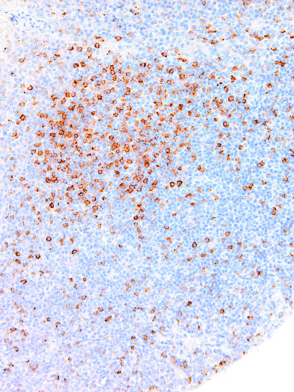 Hairy-Cell-Leukemia-IHC687-Tonsil