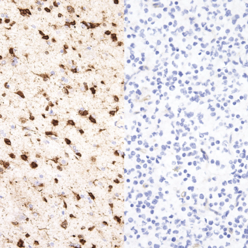 IDH1-R132H-IHC132-Glioma-pos-neg