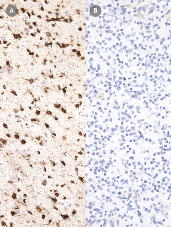 IDH1-R132H-IHC132-Glioma-pos-neg