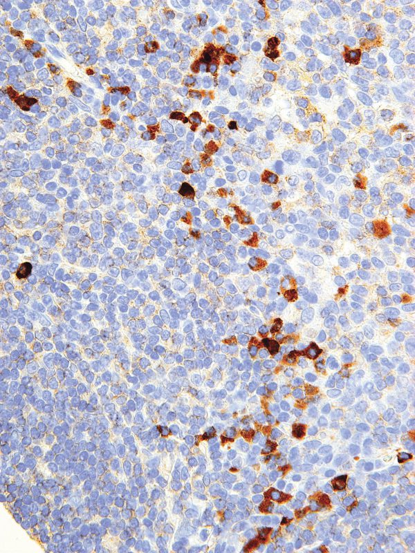 Kappa-IHC610-Tonsil