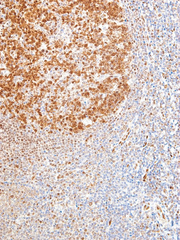 LMO2-IHC615-Tonsil