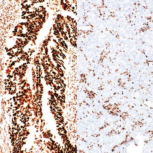 MSH6-IHC026-Colon-Cancer-pos-neg-3