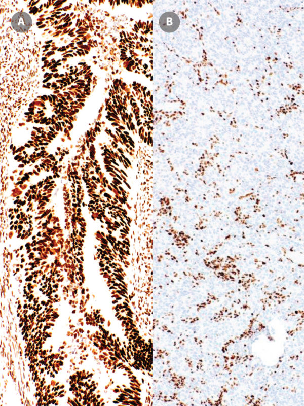 MSH6-IHC026-Colon-Cancer-pos-neg-3