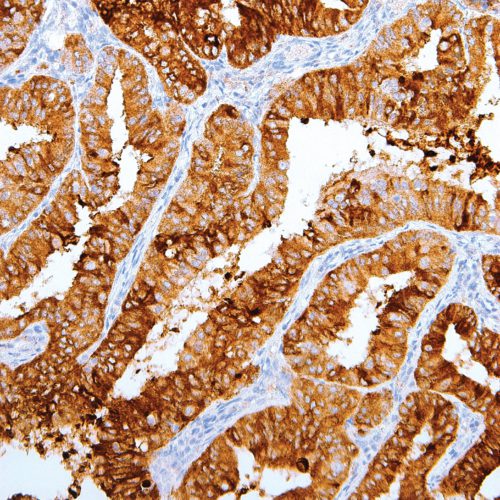 MUC1-IHC623-Endometrium