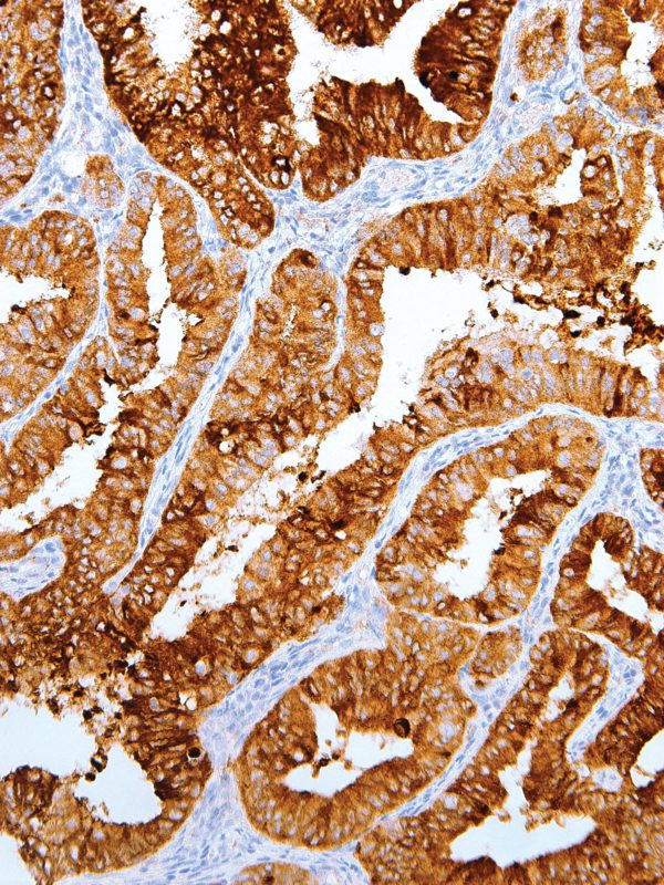 MUC1-IHC623-Endometrium