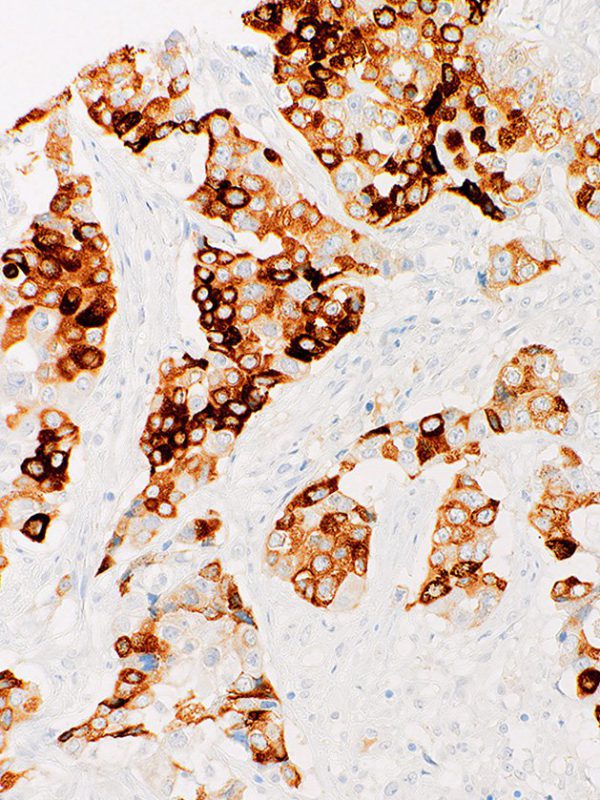 MUC6-IHC626-Pancreas