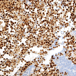Myogenin-IHC631-Rhabdomyosarcoma