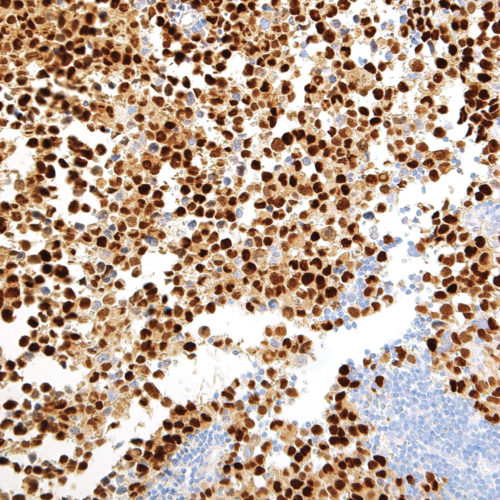 Myogenin-IHC631-Rhabdomyosarcoma