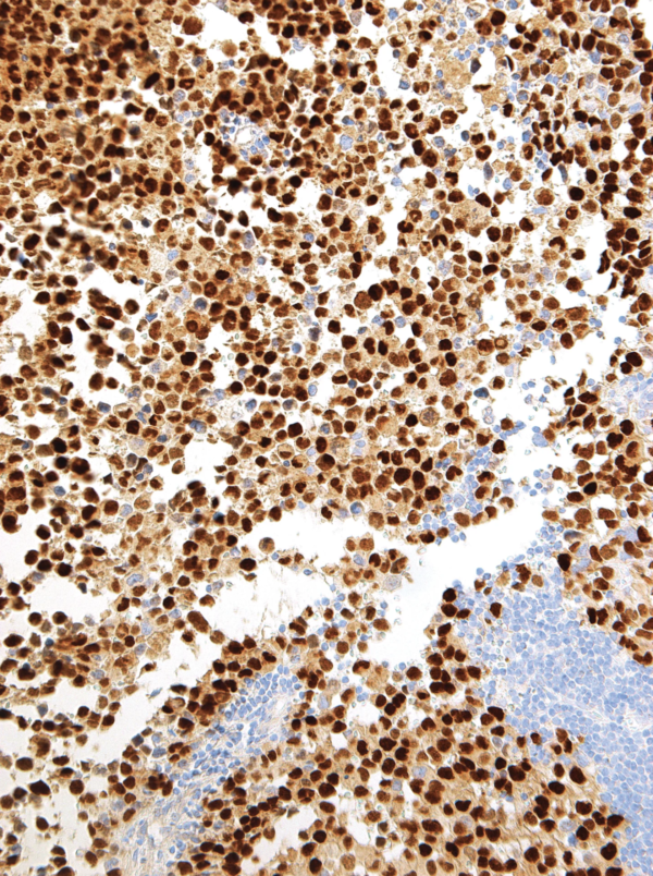 Myogenin-IHC631-Rhabdomyosarcoma