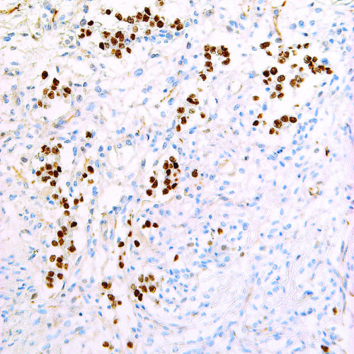 Nanog-IHC634-Yolk-Sac-Tumor