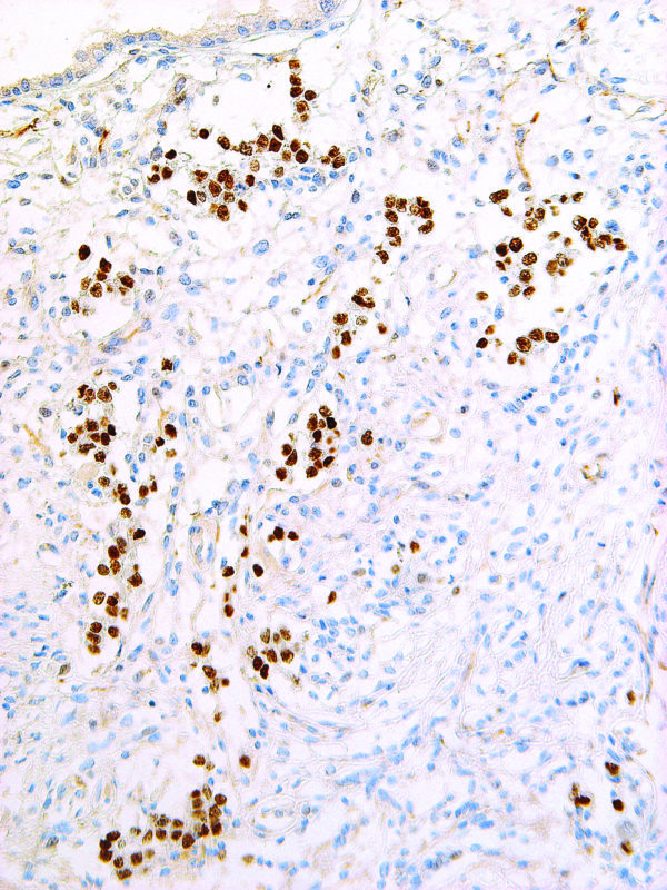 Nanog-IHC634-Yolk-Sac-Tumor