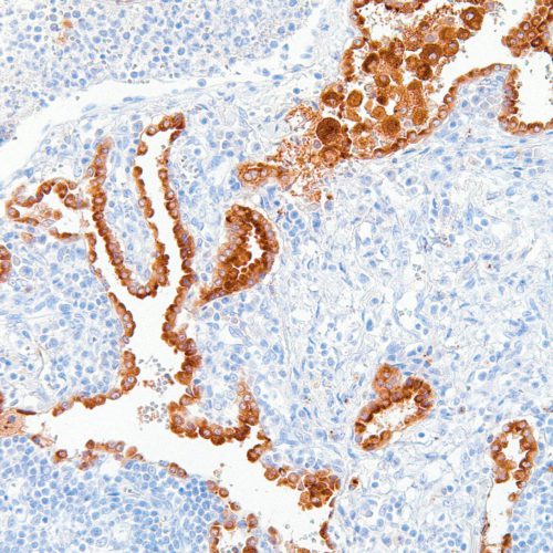 Napsin-A-IHC635-Lung