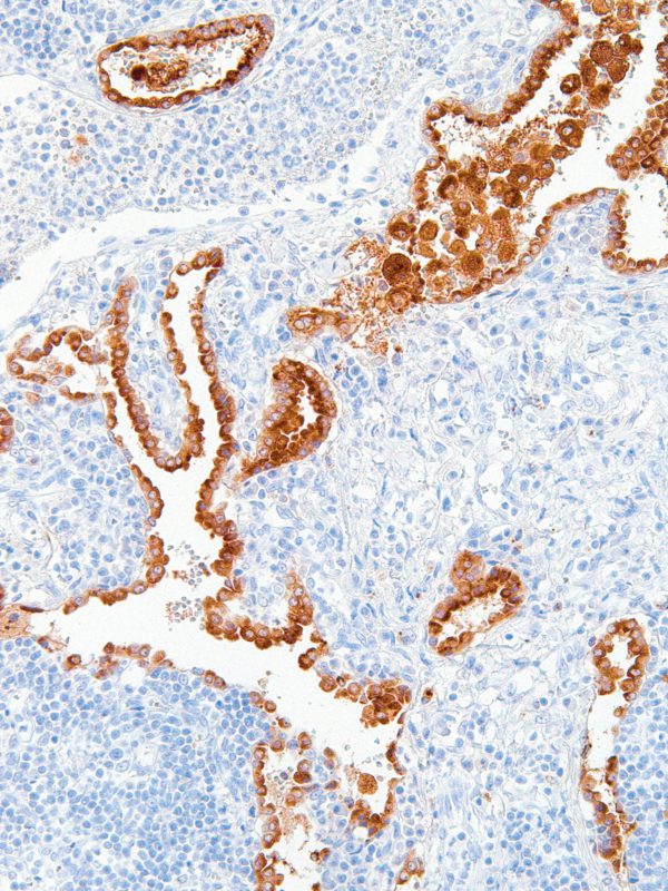 Napsin-A-IHC635-Lung