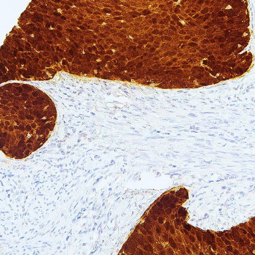 P16-IHC116-Cervical-Cancer