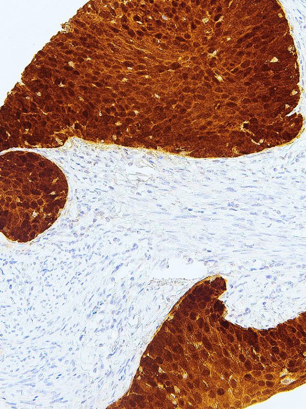 P16-IHC116-Cervical-Cancer