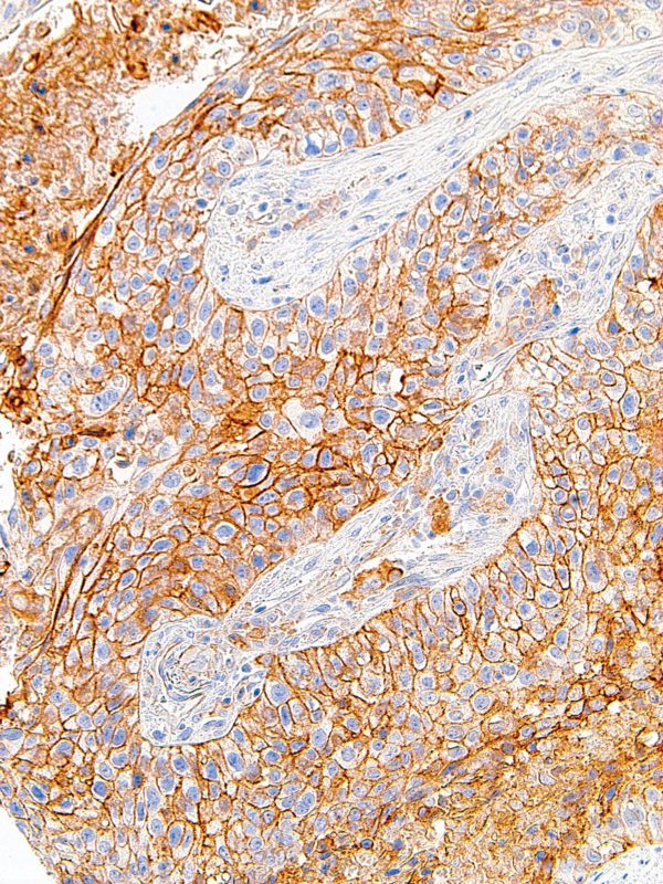 PD-L1-IHC411-Lung
