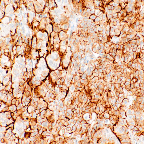 PDPN-IHC650-Mesothelia