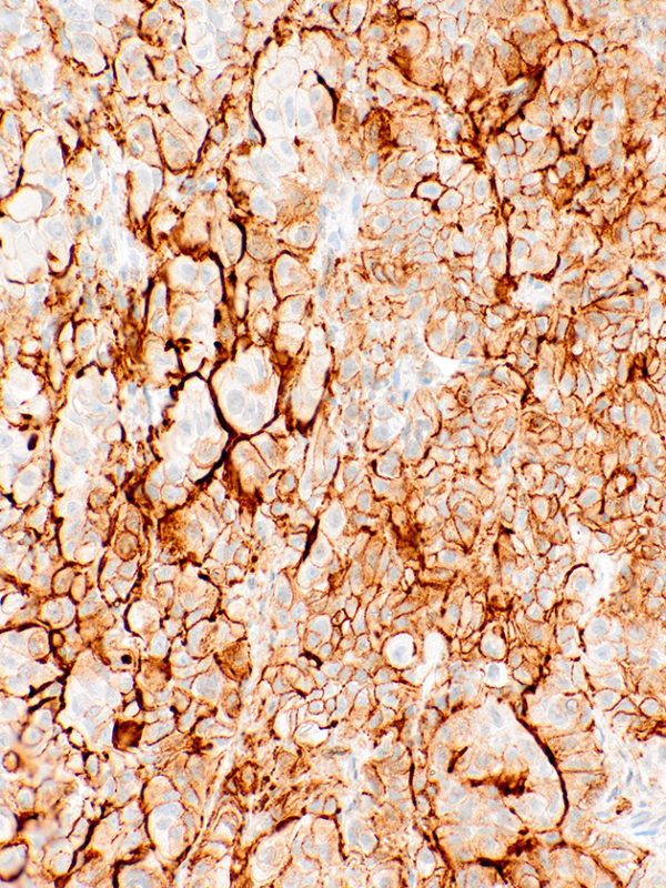 PDPN-IHC650-Mesothelia