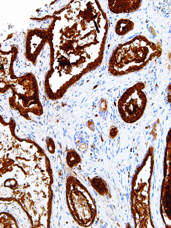 PSAP-IHC655-Prostate