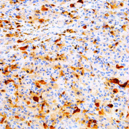 S-100-IHC100-Melanoma