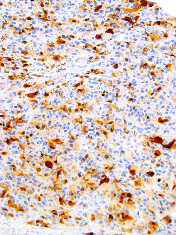 S-100-IHC100-Melanoma