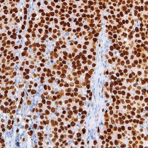 SALL4-IHC659-Seminoma