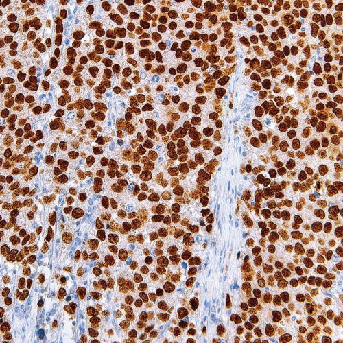 SALL4-IHC659-Seminoma