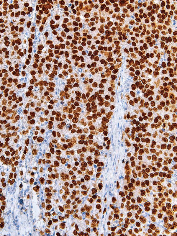 SALL4-IHC659-Seminoma