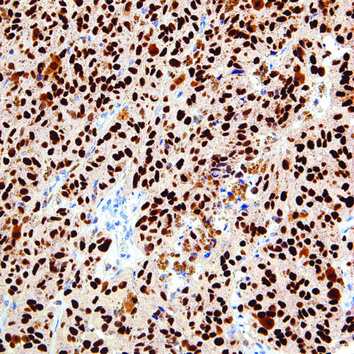 SOX10-IHC010-Melanoma