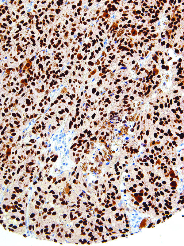 SOX10-IHC010-Melanoma