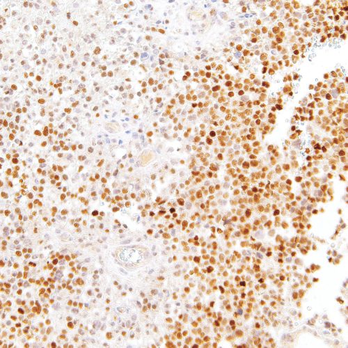 SOX11-IHC011-Glioma