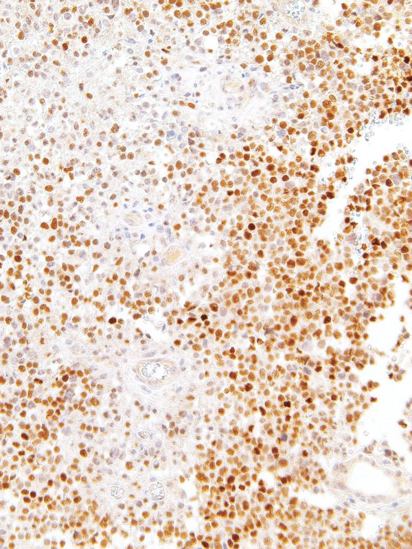 SOX11-IHC011-Glioma